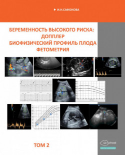 Беременность высокого риска: Допплер. Биофизический профиль. Фетометрия. Том 2 - И.Н.Сафонова